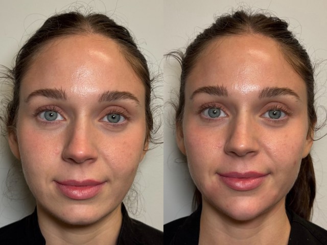 A little Radiesse appreciation 🤍✨ These before & afters say it all. Radiesse works by stimulating your body’s natural collagen production while instantly adding volume and structure—giving results that look refreshed, lifted, and natural over time. We love it for sculpting, restoring volume, softening lines, and creating that healthy, youthful glow without looking overdone.
And for the month of May only:
✨ Buy 1 syringe, get 1 half off
✨ Buy 2 syringes, get 1 FREE
If Radiesse has been on your mind, this is your sign to book 😉
#charlestonmedspa #radiesse #facialbalancing #aesthetics #charlestonwellness
