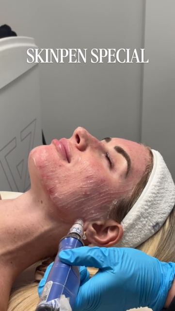✨ Your skin goals just got rewarded ✨ Now through June 30th, when you purchase a series of 3 SkinPen treatments for $1100, you’ll receive a $100 rebate back from SkinPen in the form of a gift card 🤍
SkinPen is one of our favorite treatments for:
• Smoother texture
• Acne scarring
• Fine lines + wrinkles
• Collagen stimulation
• Healthy, glowing skin with minimal downtime ✨
Your investment in your skin now comes with a little something extra 👏 Once you purchase your series, simply submit through the SkinPen rebate link and SkinPen will send you a $100 gift card.
Offer ends June 30th —book your appointment through the link in our bio to get started ✨
#charlestonmedspa #skinpen #charlestonwellness #acnescartreatment #finelines