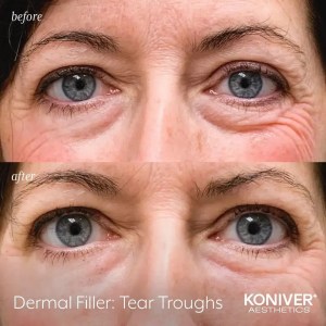 dermal fillers charleston sc before after results