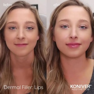 dermal fillers before after results