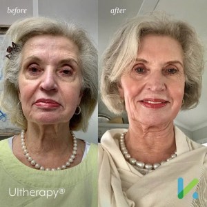 skin tightening charleston sc before after