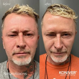 microneedling charleston sc before after