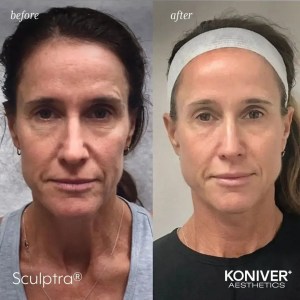 sculptra charleston sc before after results
