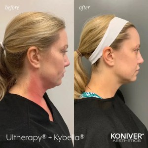 ultherapy charleston sc before after
