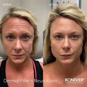 Neurotoxins Injection results in Charleston, SC