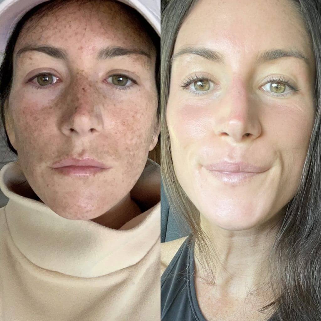 laser skin resurfacing before after