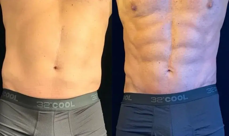 man body contouring charleston sc